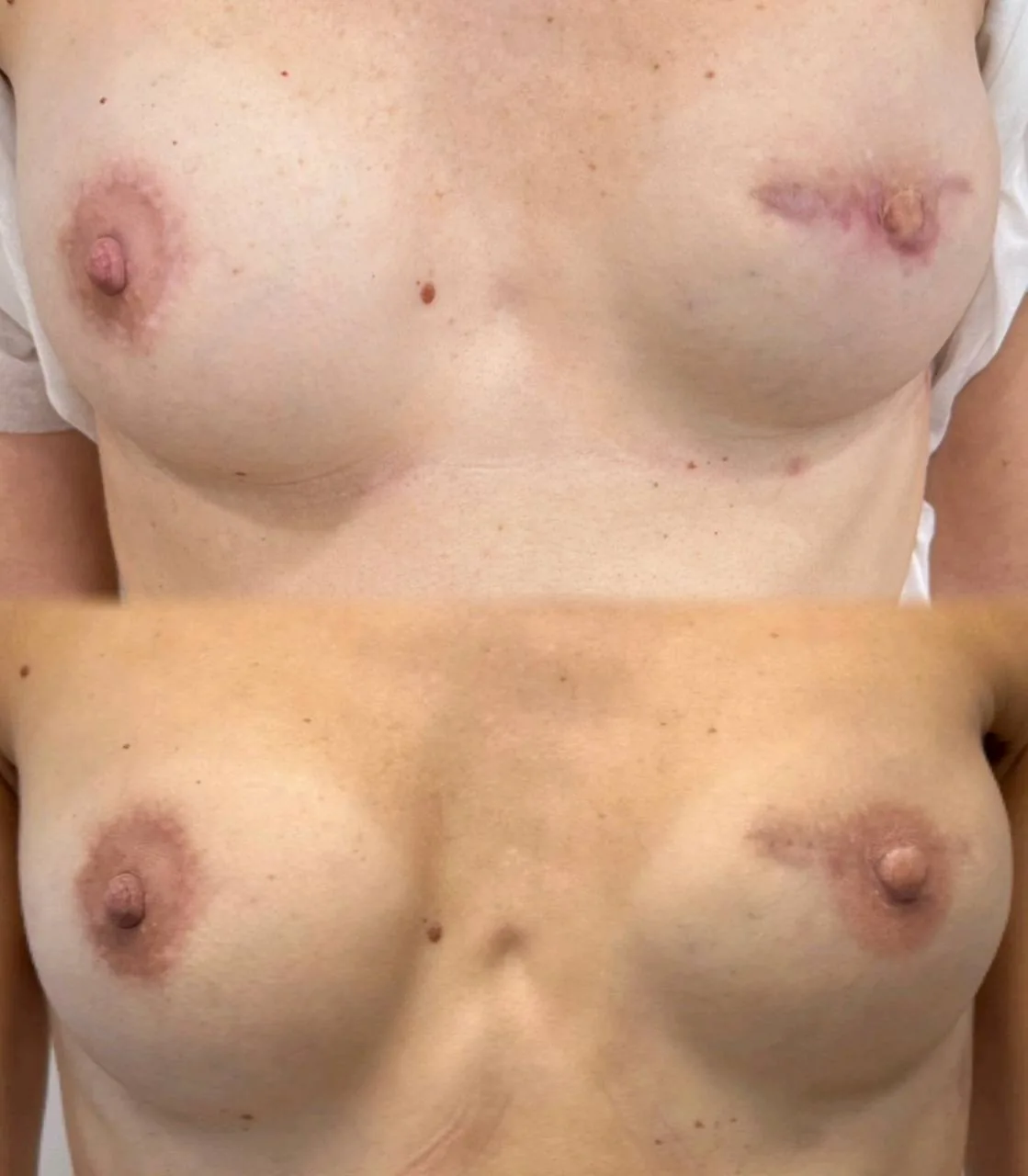 Медицинский камуфляж рубца после abdominoplasty — результат до и после процедуры